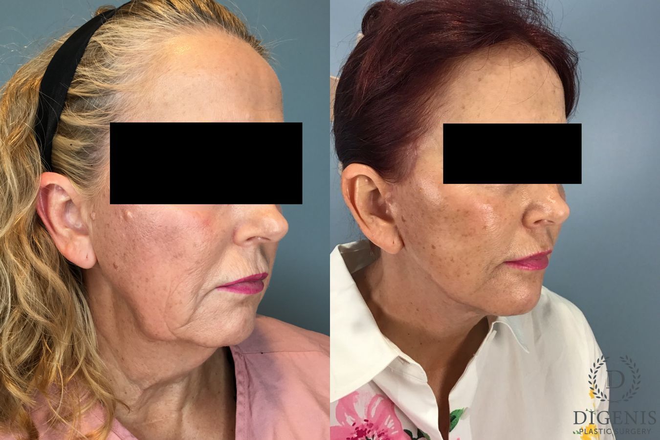 Before and after Face Lift/Neck Lift case 46141 - Angle 4