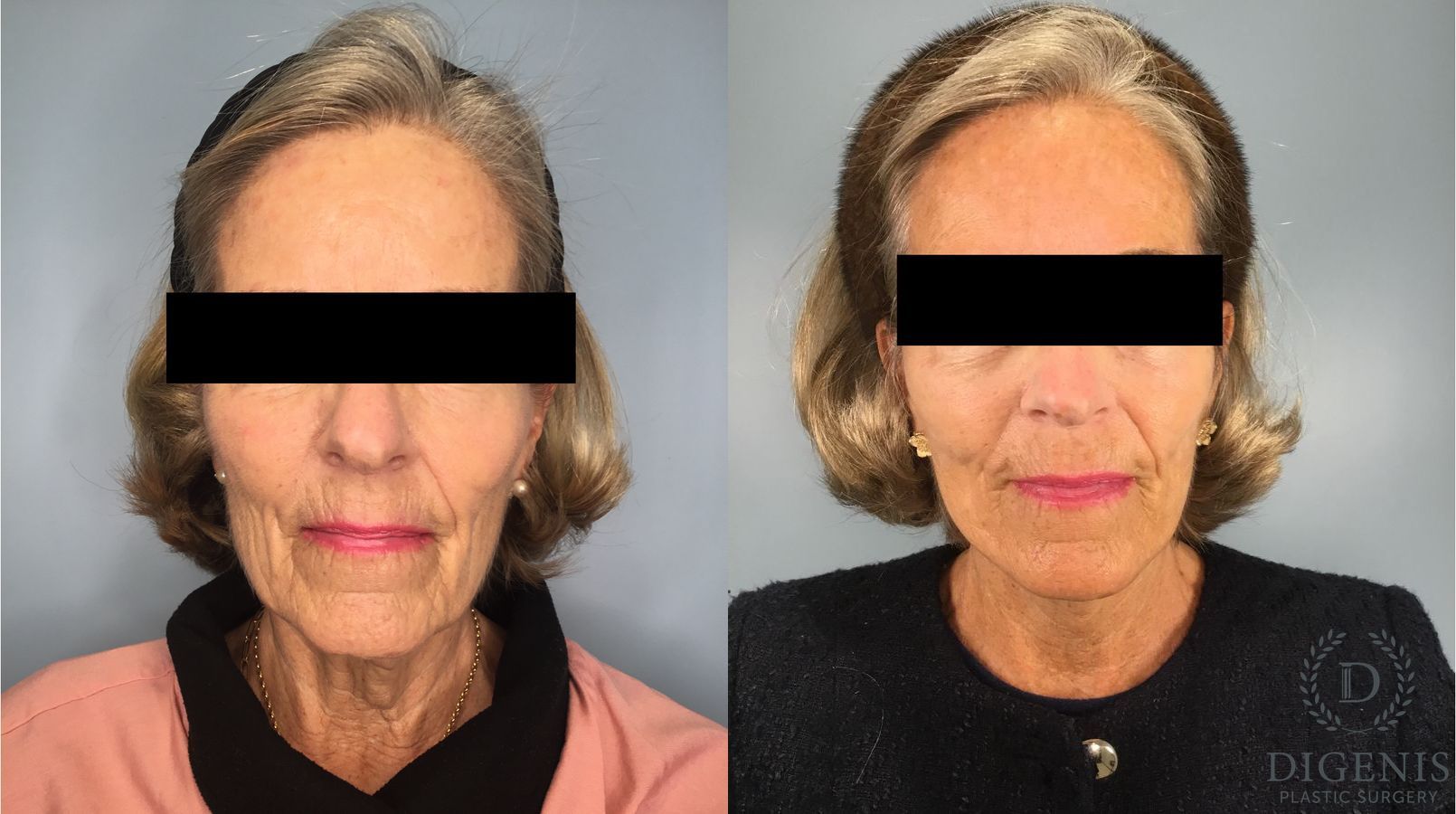 Before and after Face Lift/Neck Lift case 41847