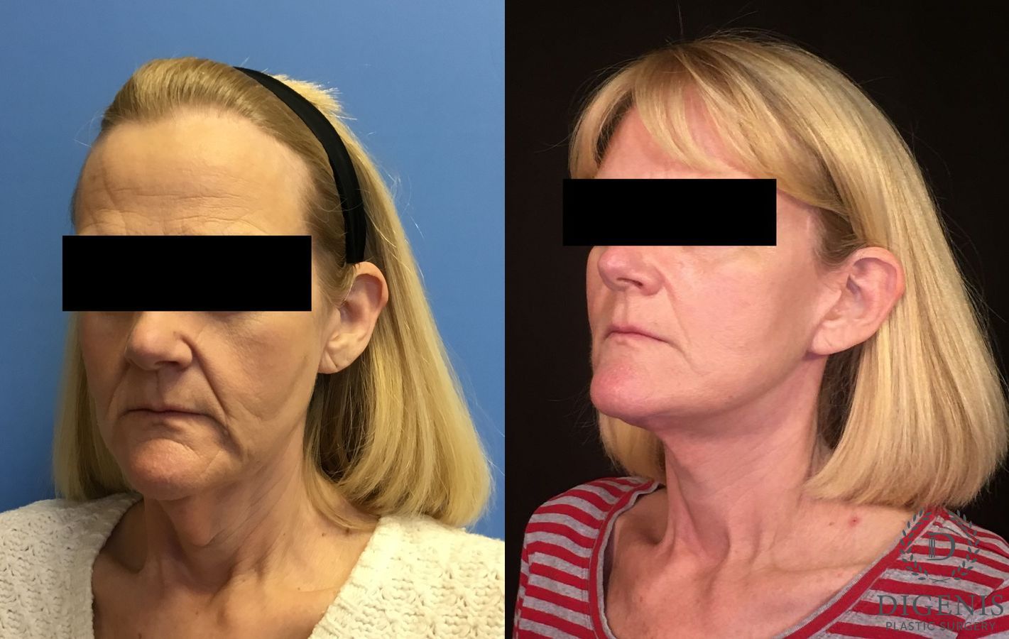 Before and after Face Lift/Neck Lift case 34964 - Angle 4
