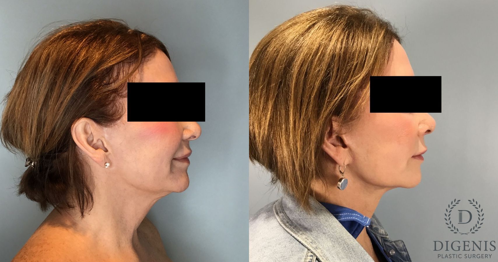 Before and after Face Lift/Neck Lift case 45831 - Angle 3