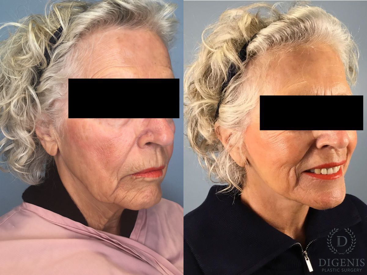 Before and after Face Lift/Neck Lift case 41357 - Angle 3