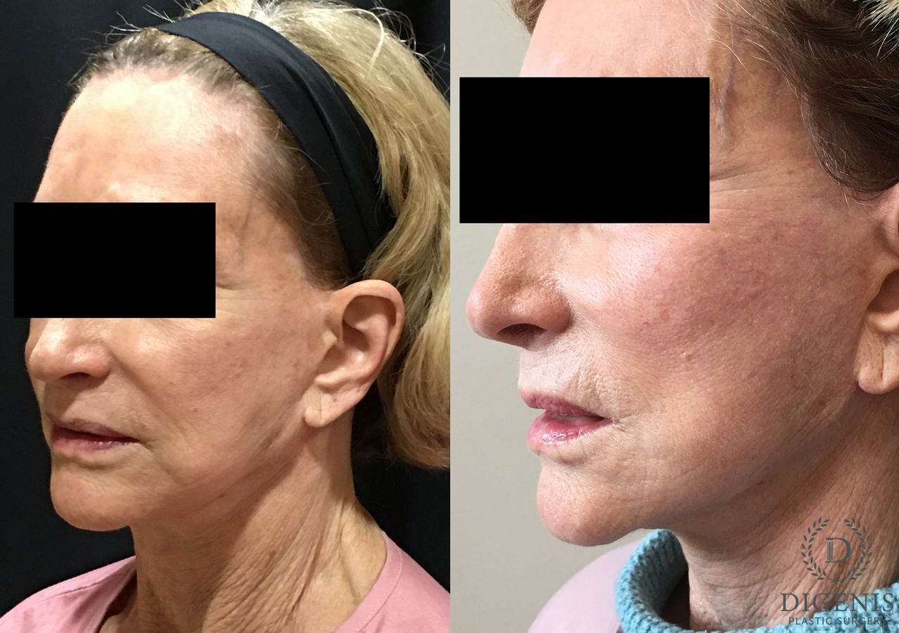 Before and after Face Lift/Neck Lift case 34985 - Angle 4