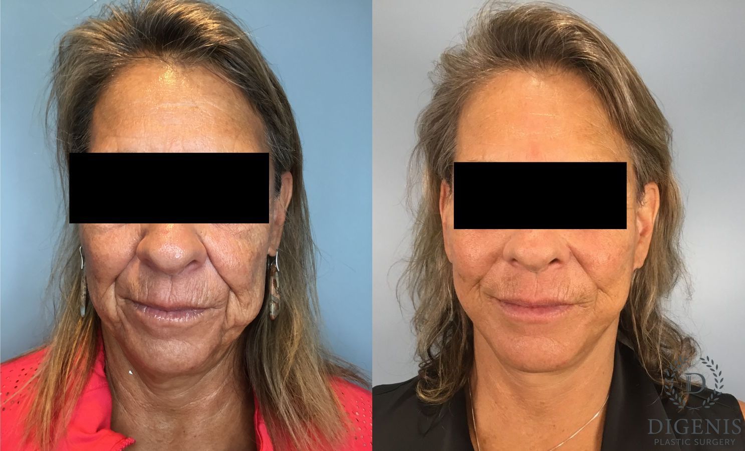 Before and after Face Lift/Neck Lift case 41925