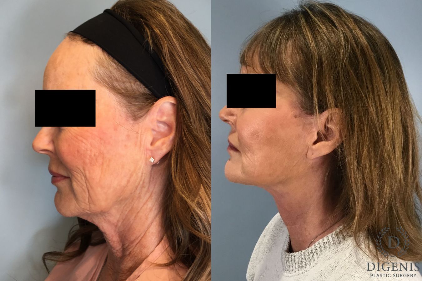 Before and after Face Lift/Neck Lift case 43259 - Angle 4