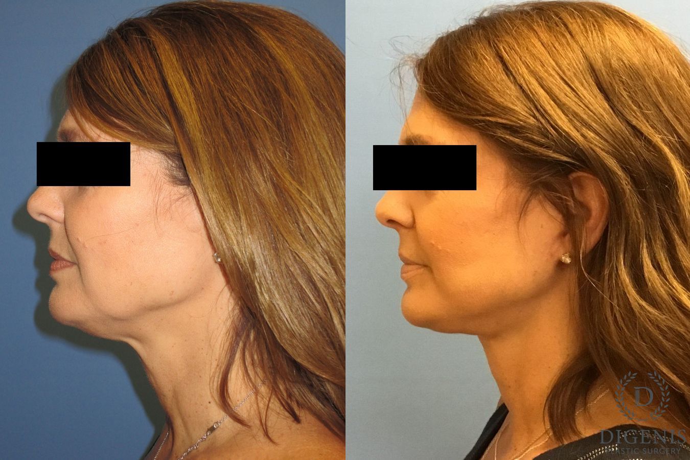 Before and after Face Lift/Neck Lift case 34978 - Angle 5