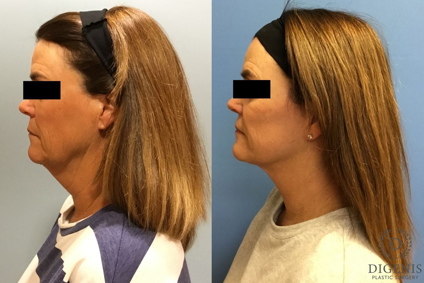 Before and after Face Lift/Neck Lift case 34966 - Angle 5