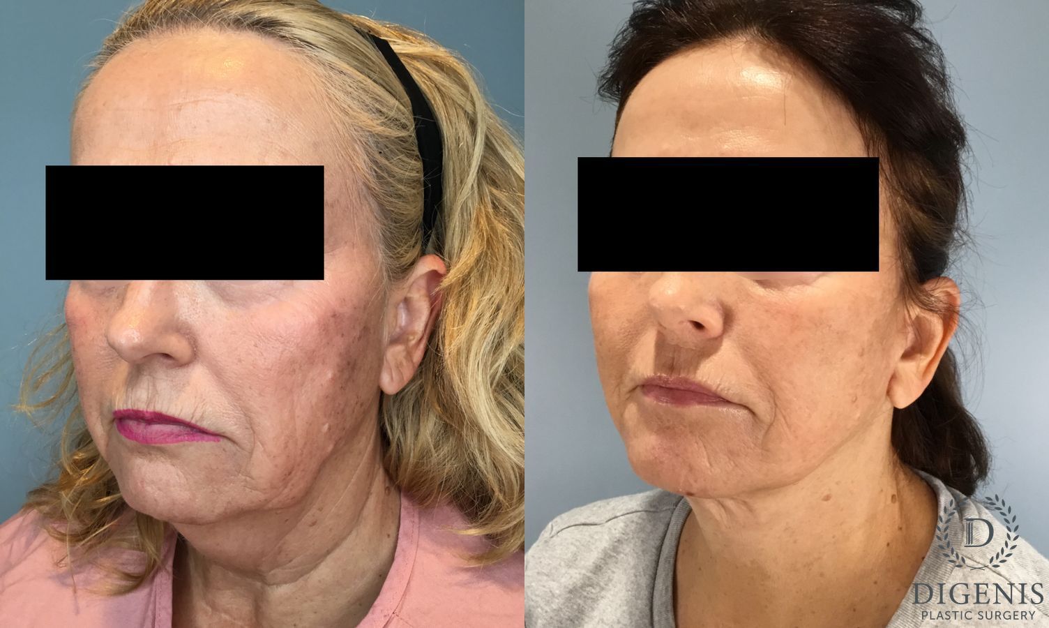 Before and after Face Lift/Neck Lift case 46141 - Angle 2