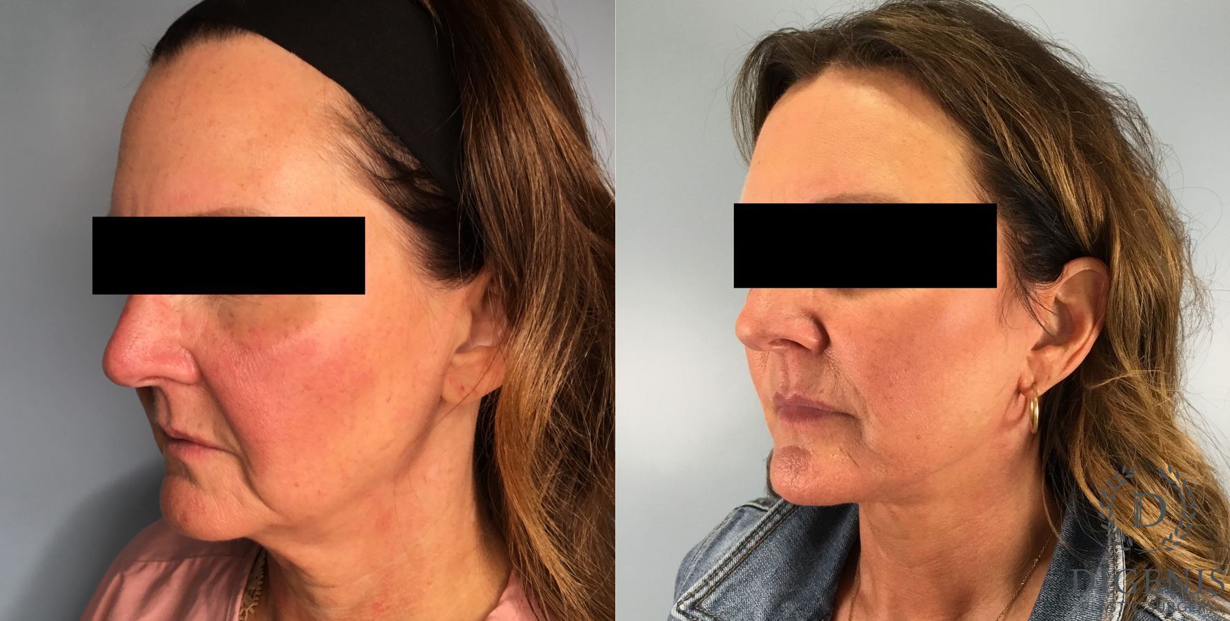 Before and after Face Lift/Neck Lift case 41696 - Angle 2