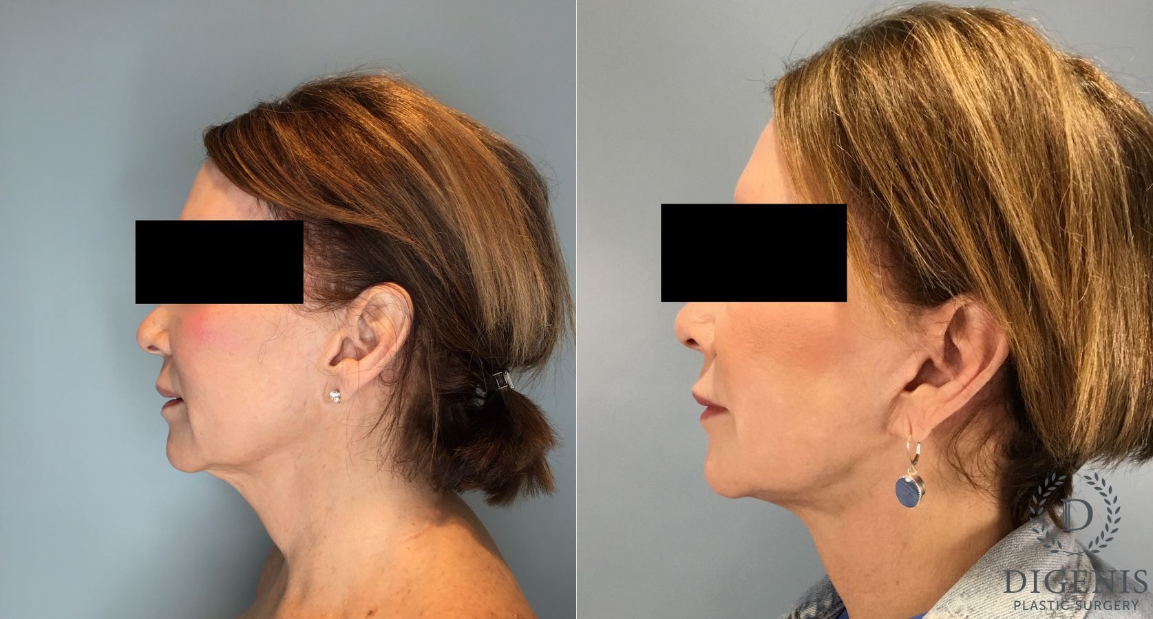 Before and after Face Lift/Neck Lift case 45831 - Angle 5