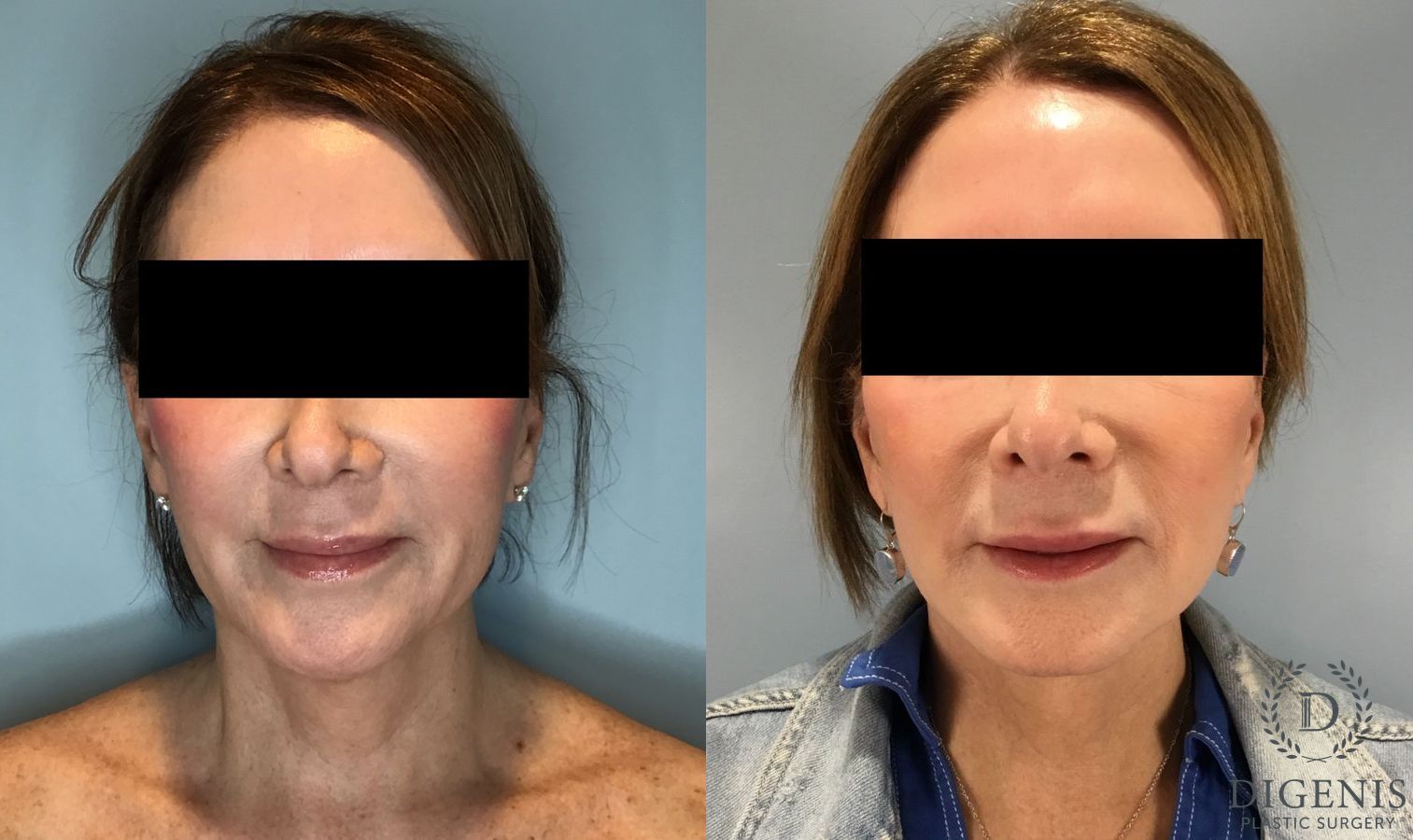 Before and after Face Lift/Neck Lift case 45831