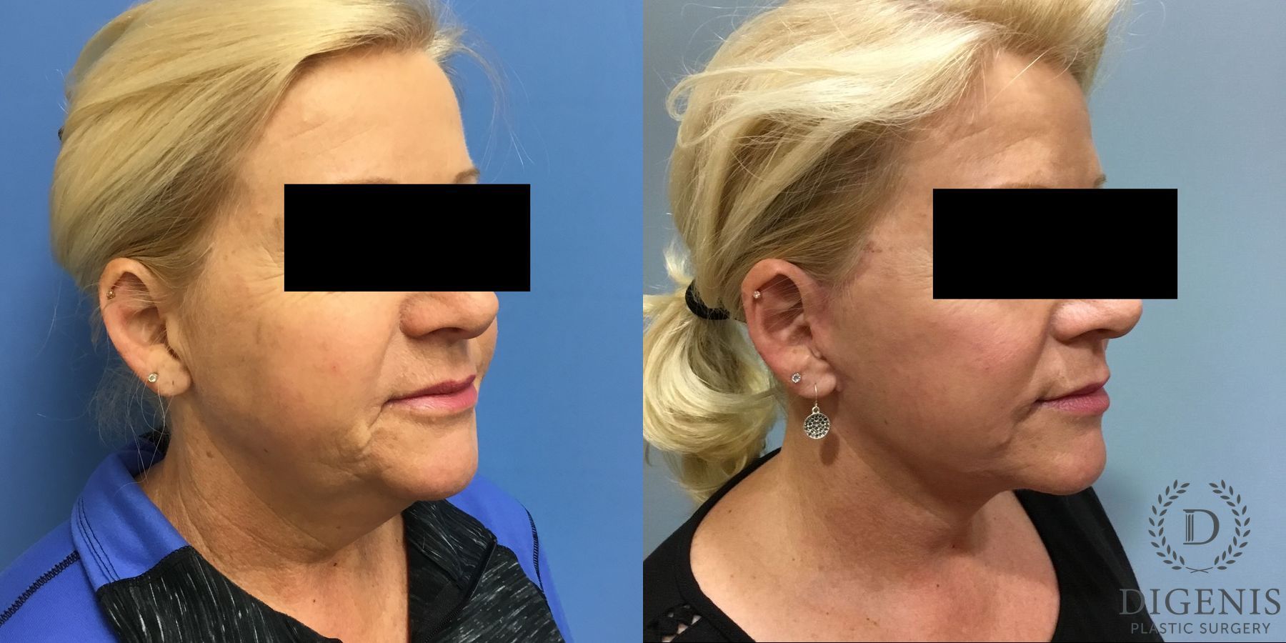 Before and after Face Lift/Neck Lift case 34961 - Angle 2