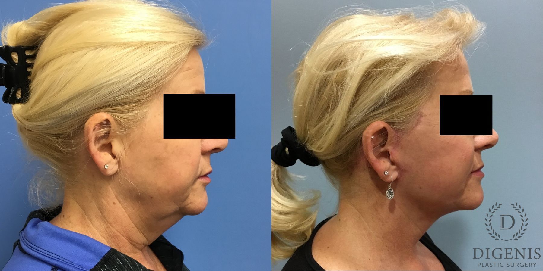 Before and after Face Lift/Neck Lift case 34961 - Angle 3