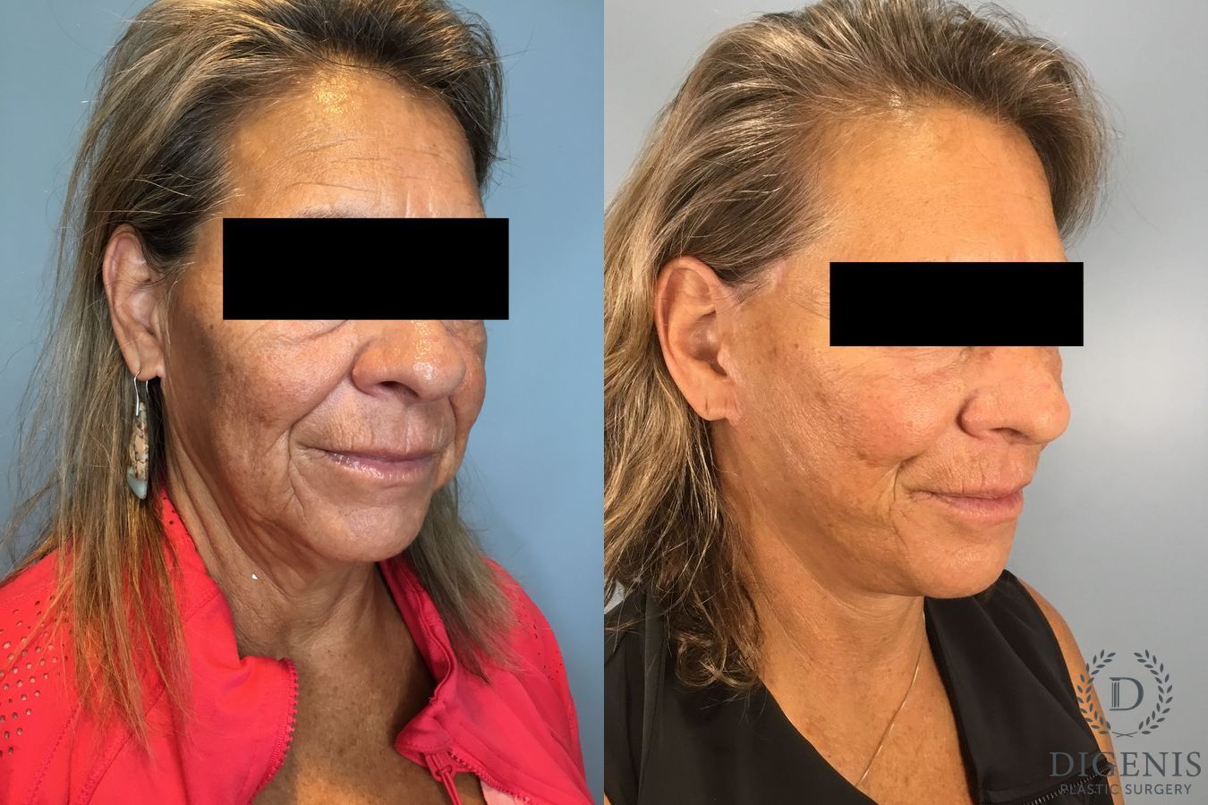 Before and after Face Lift/Neck Lift case 41925 - Angle 5