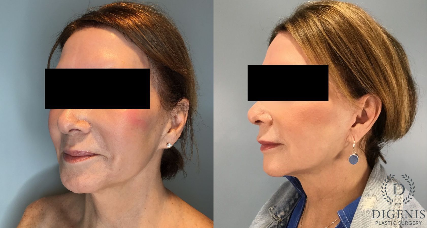 Before and after Face Lift/Neck Lift case 45831 - Angle 4