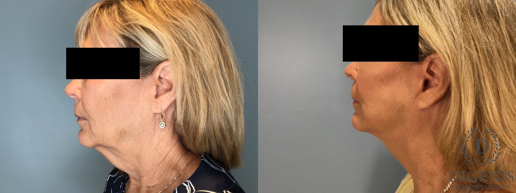Before and after Face Lift/Neck Lift case 45832 - Angle 5
