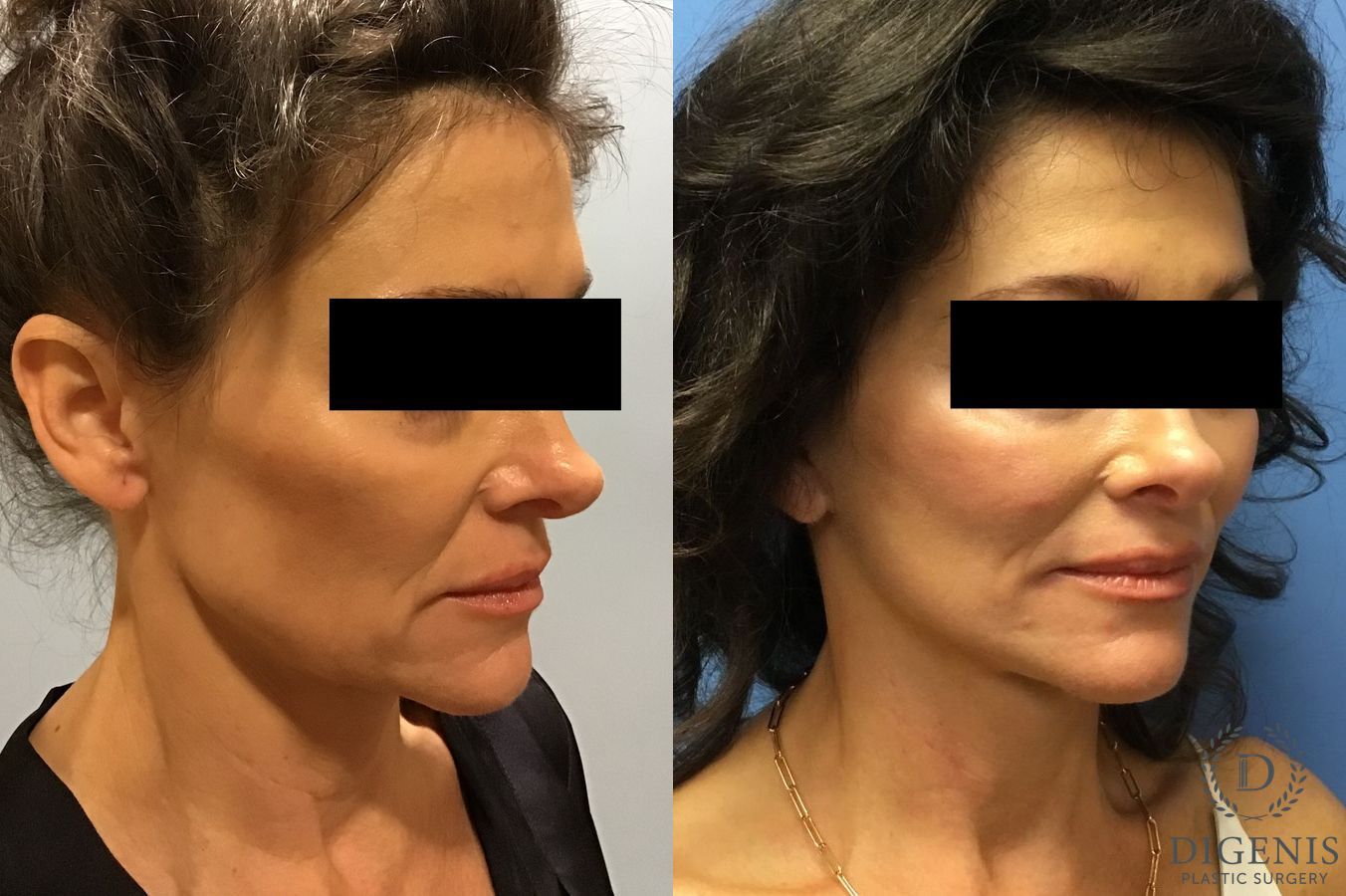 Before and after Face Lift/Neck Lift case 34982 - Angle 4