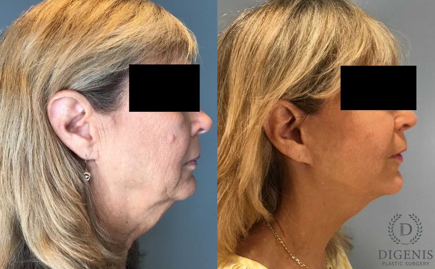 Before and after Face Lift/Neck Lift case 45832 - Angle 3
