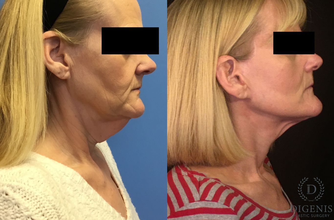 Before and after Face Lift/Neck Lift case 34964 - Angle 3