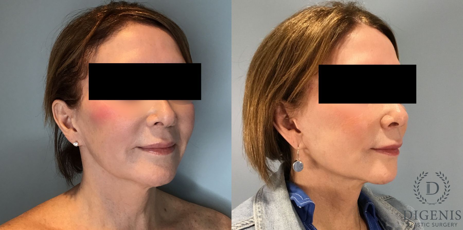 Before and after Face Lift/Neck Lift case 45831 - Angle 2