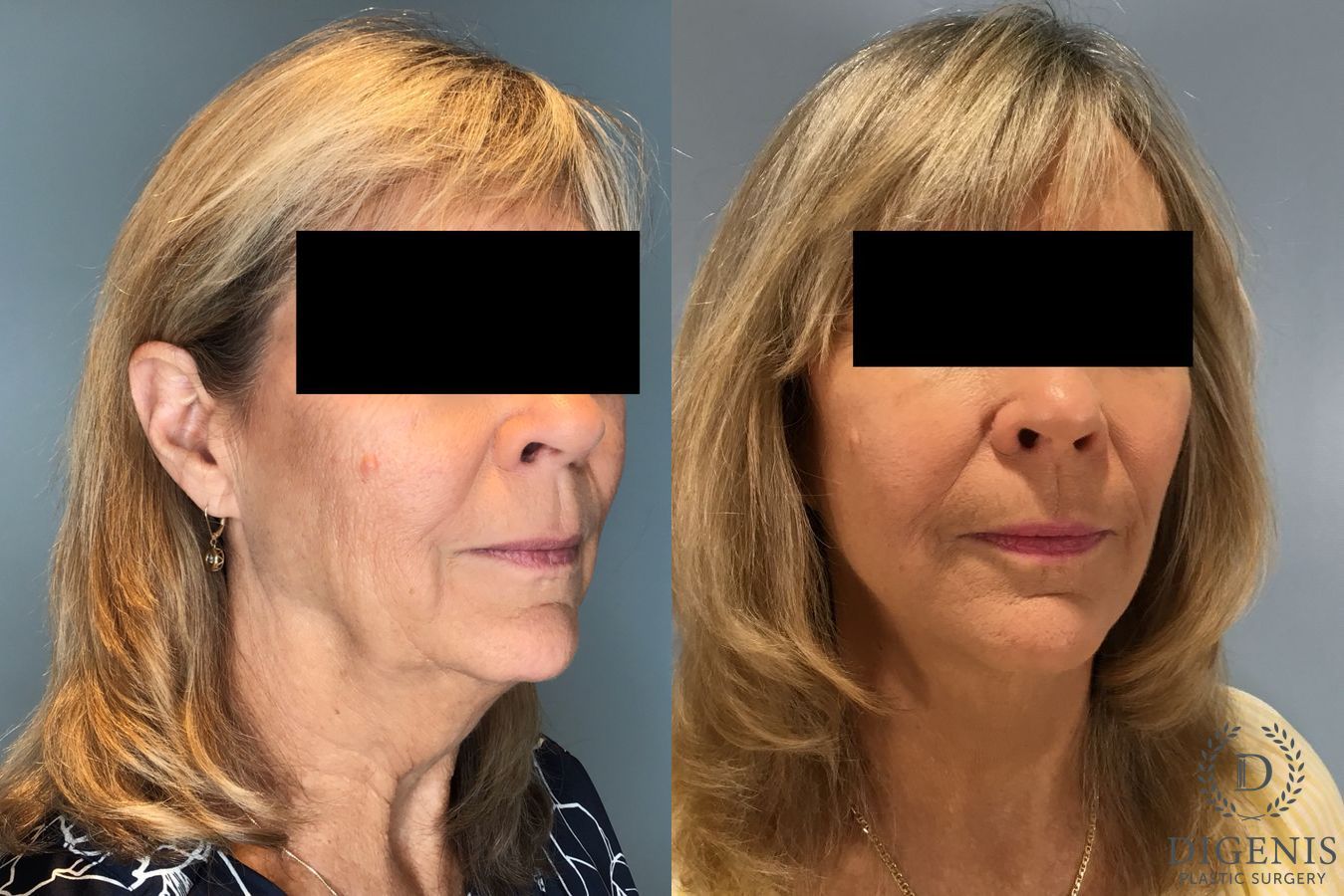 Before and after Face Lift/Neck Lift case 45832 - Angle 2