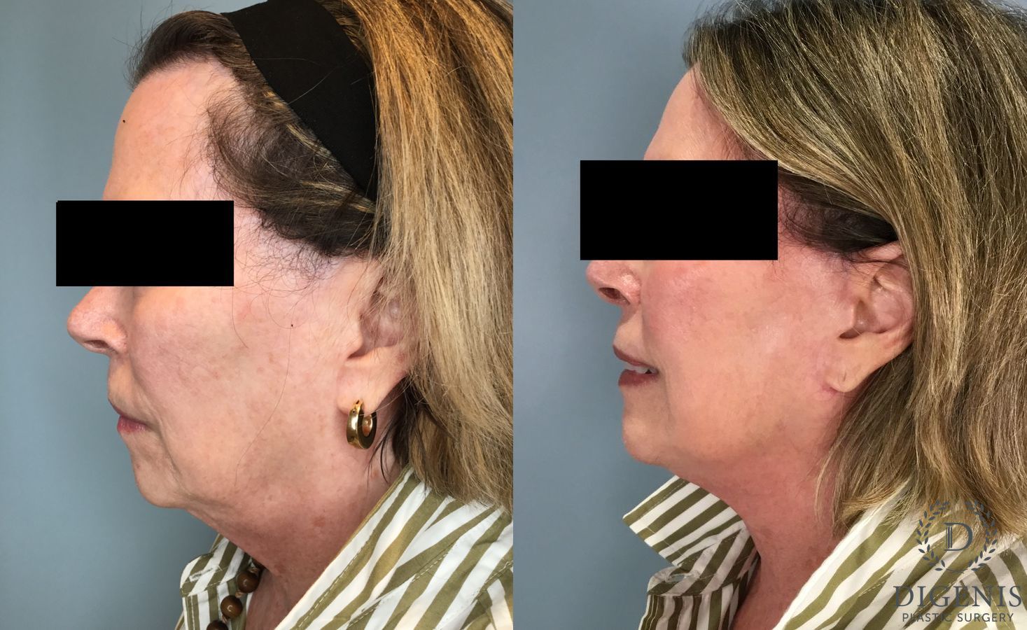 Before and after Face Lift/Neck Lift case 43260 - Angle 3