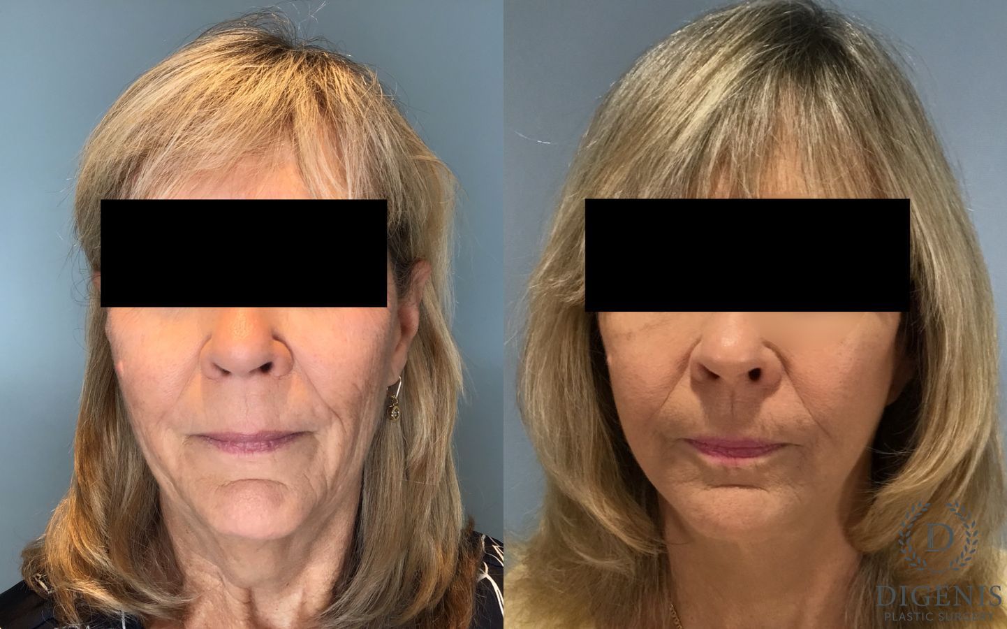 Before and after Face Lift/Neck Lift case 45832