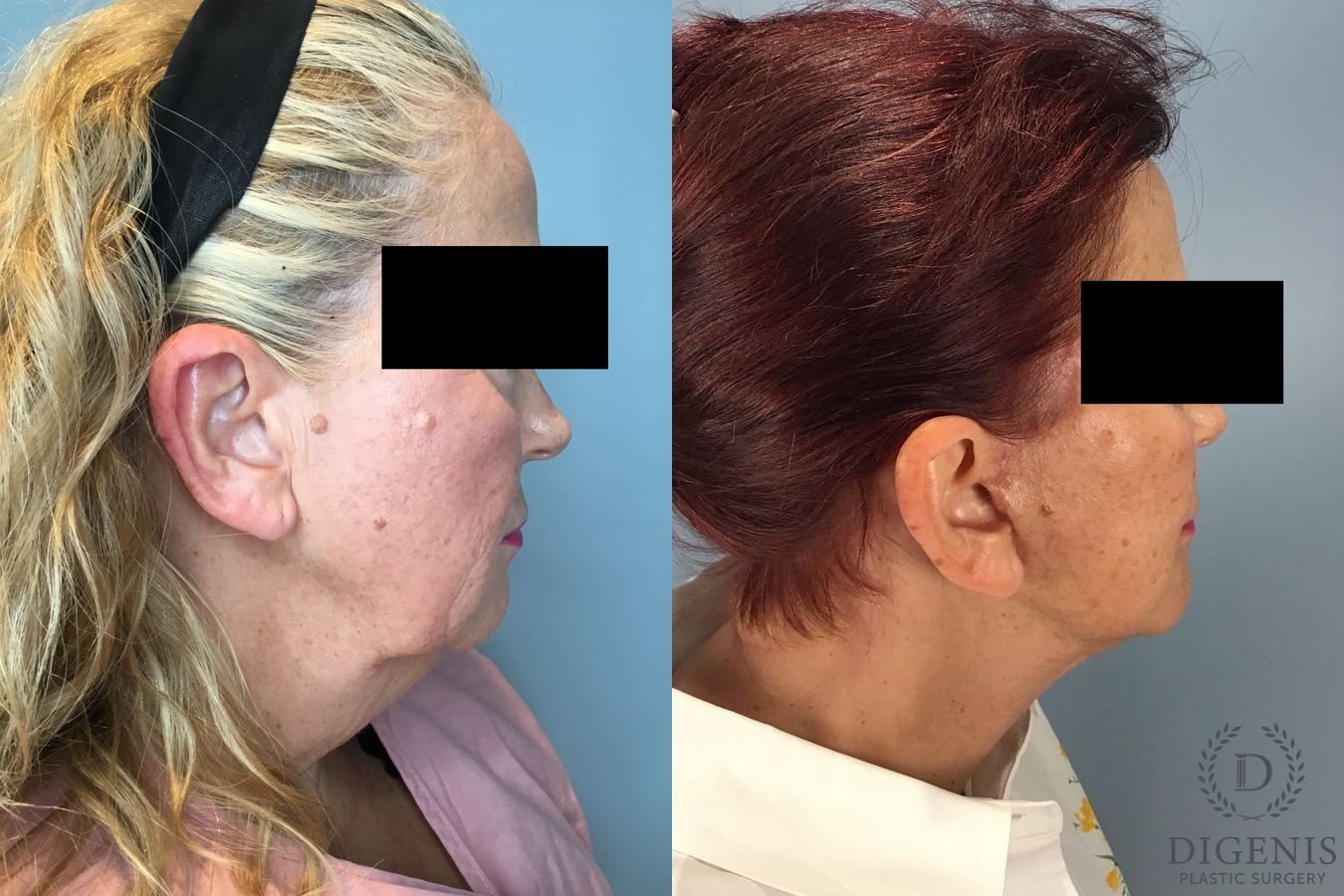 Before and after Face Lift/Neck Lift case 46141 - Angle 5