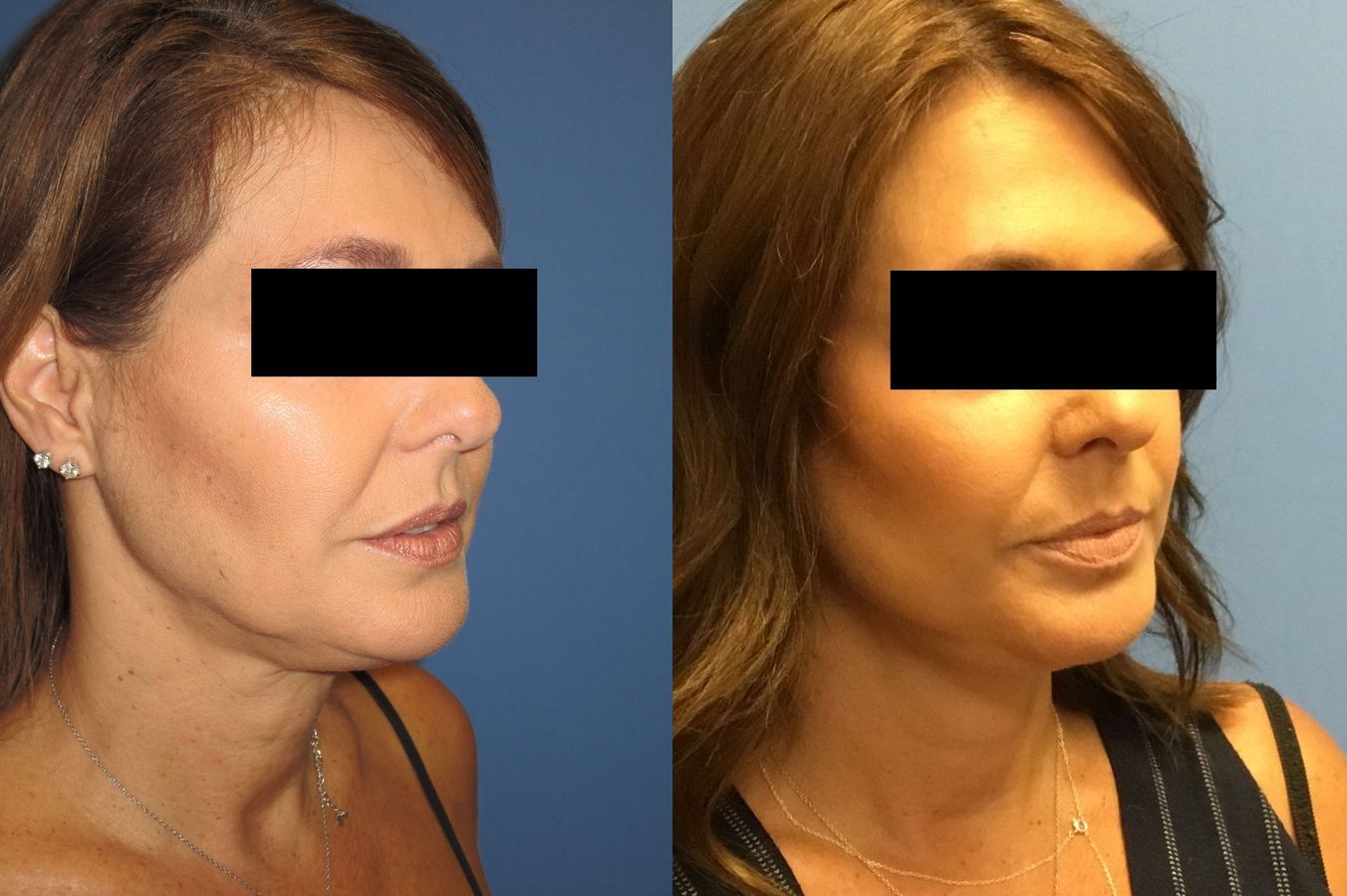 Before and after Facelift case 34978 - Angle 2