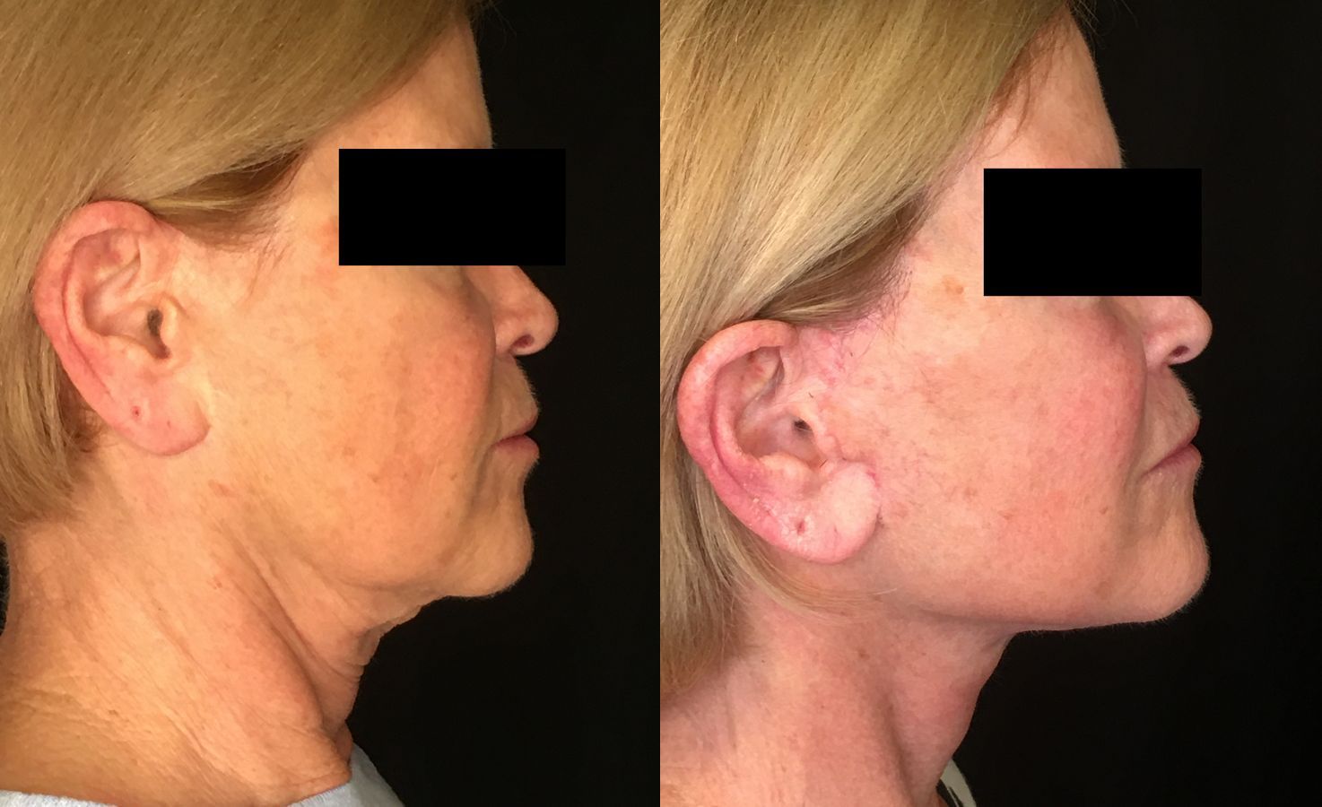 Before and after Face Lift/Neck Lift case 34974 - Angle 3