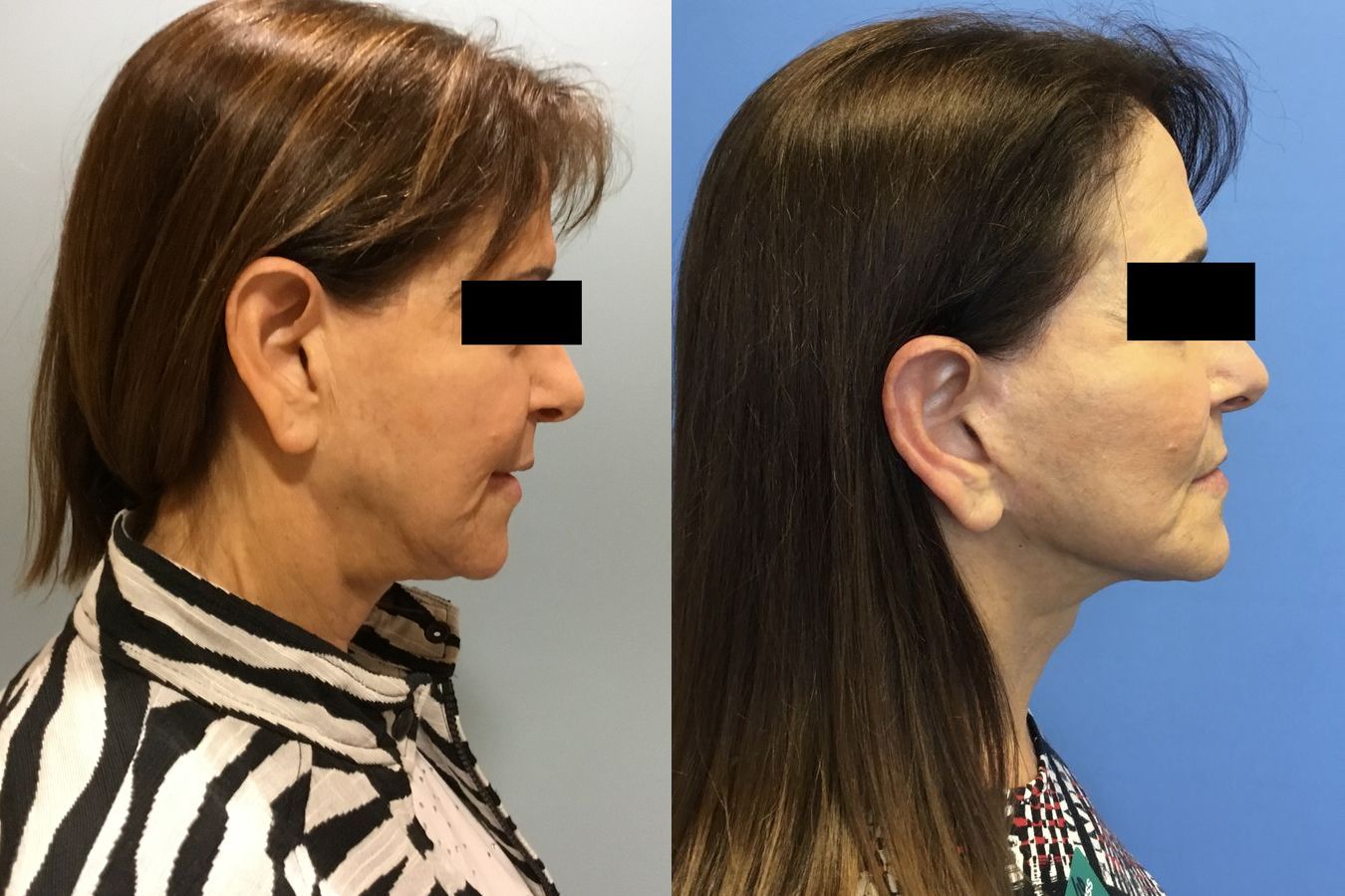 Before and after Face Lift/Neck Lift case 34963 - Angle 3