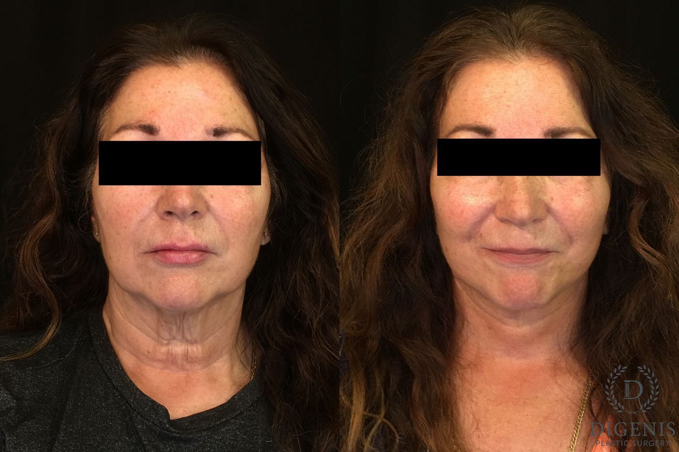 Before and after Facelift case 34960