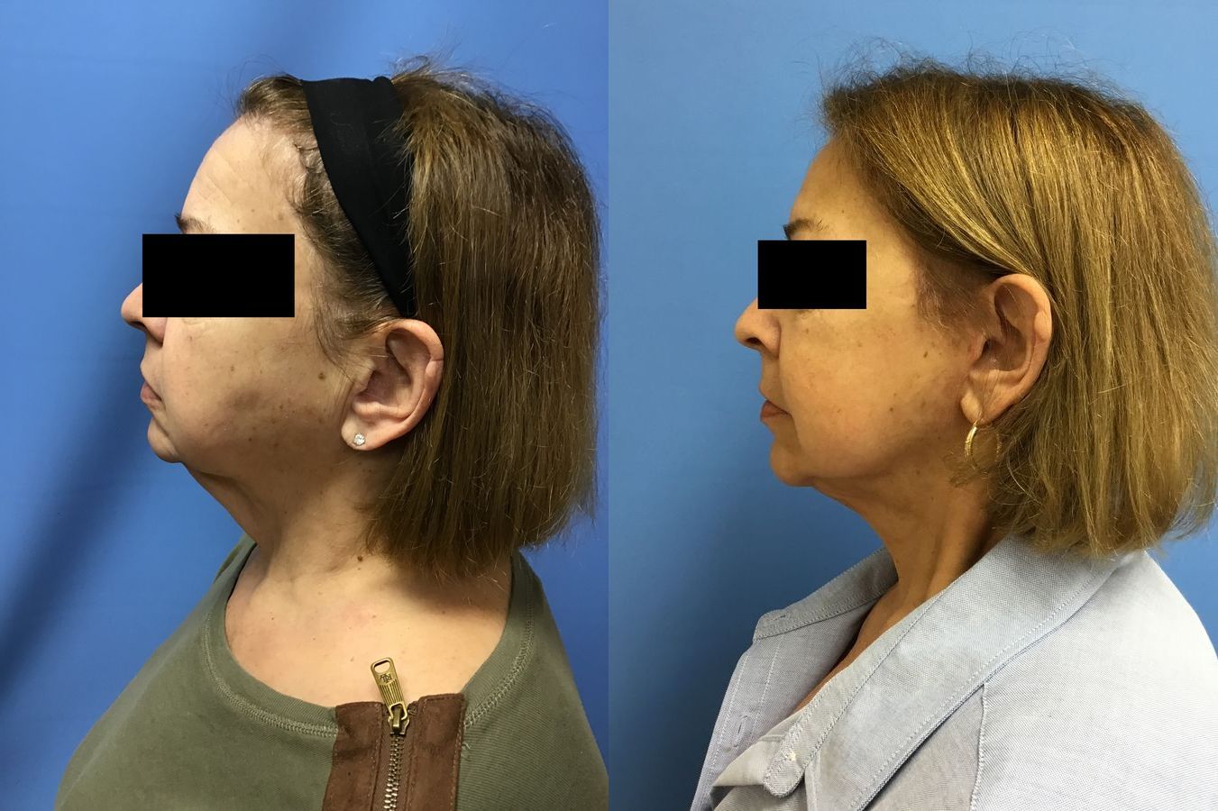 Before and after Facelift case 34970 - Angle 5