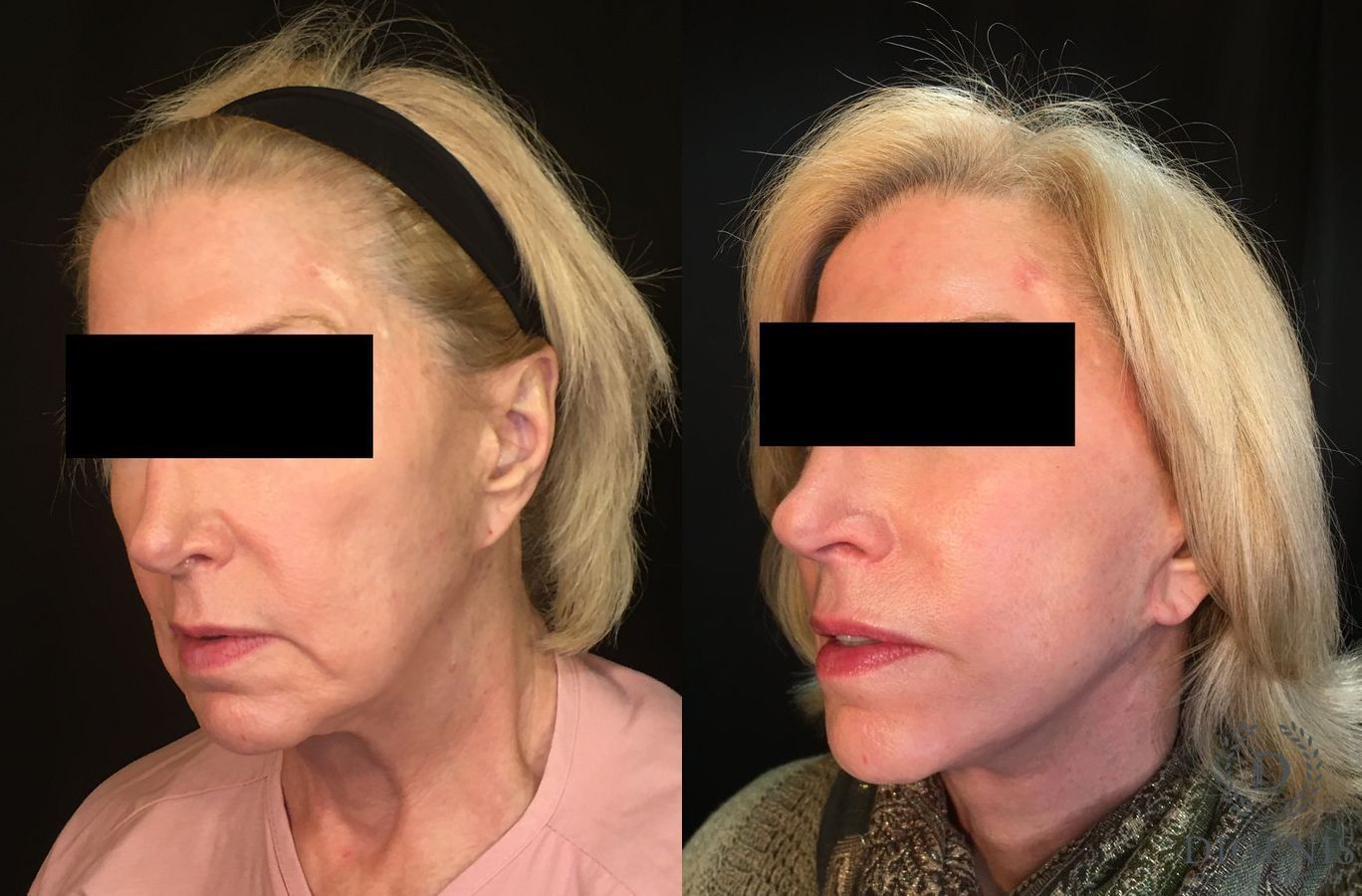 Before and after Face Lift/Neck Lift case 34996 - Angle 4