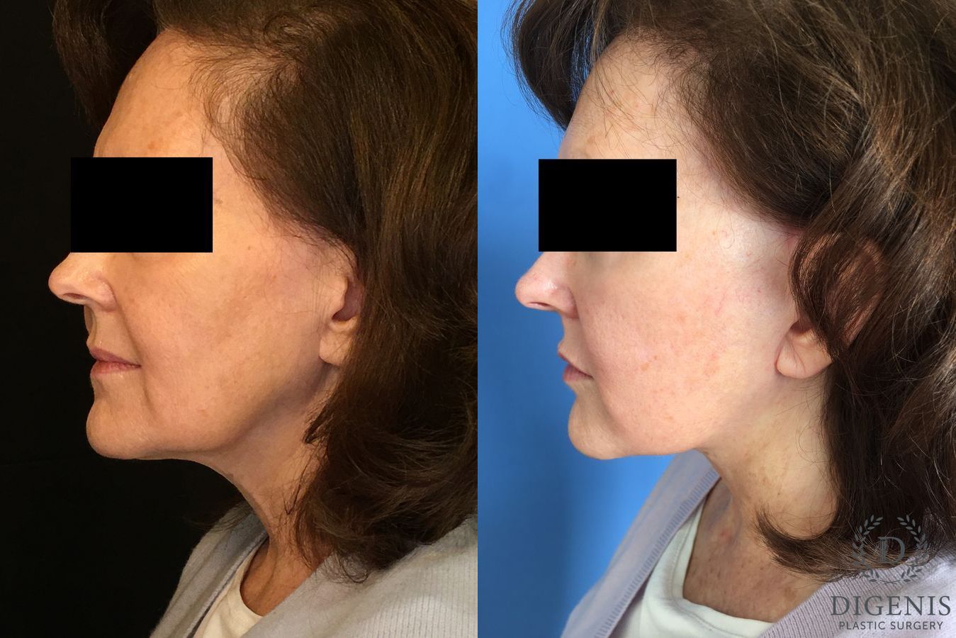 Before and after Face Lift/Neck Lift case 34993 - Angle 4