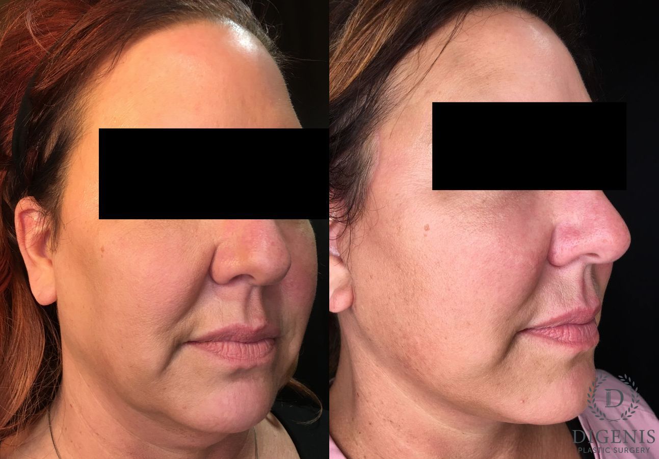 Before and after Face Lift/Neck Lift case 34994 - Angle 2