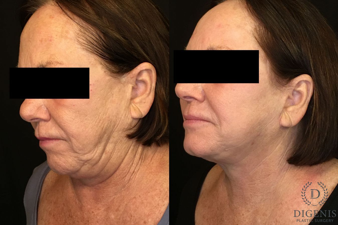 Before and after Face Lift/Neck Lift case 34989 - Angle 4