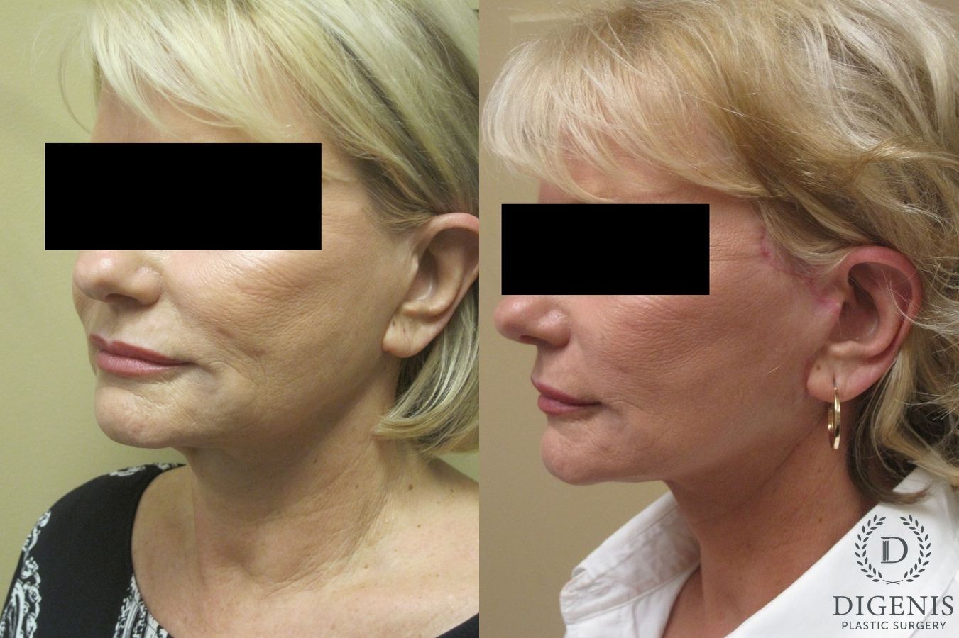 Before and after Face Lift/Neck Lift case 34977 - Angle 4