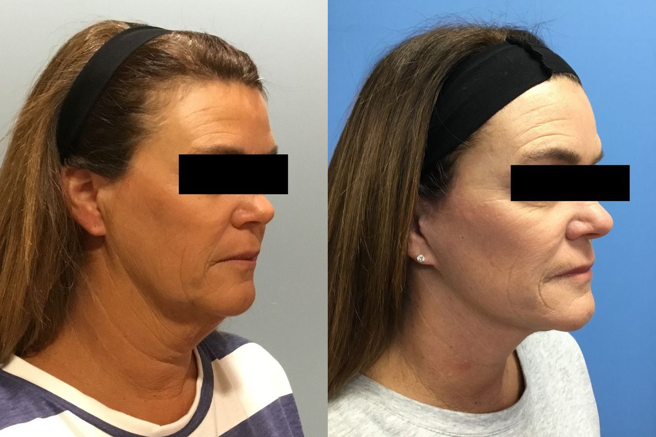Before and after Facelift case 34966 - Angle 2
