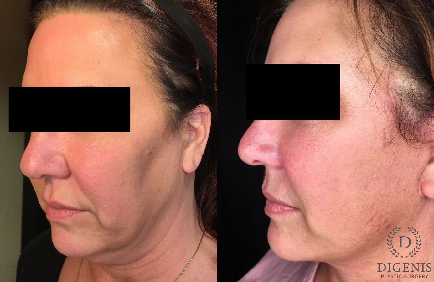 Before and after Face Lift/Neck Lift case 34994 - Angle 4