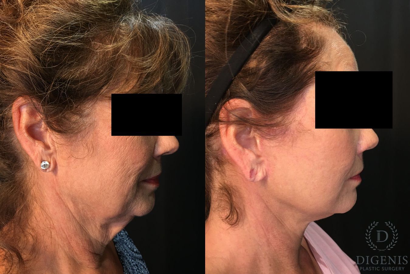 Before and after Face Lift/Neck Lift case 34992 - Angle 3