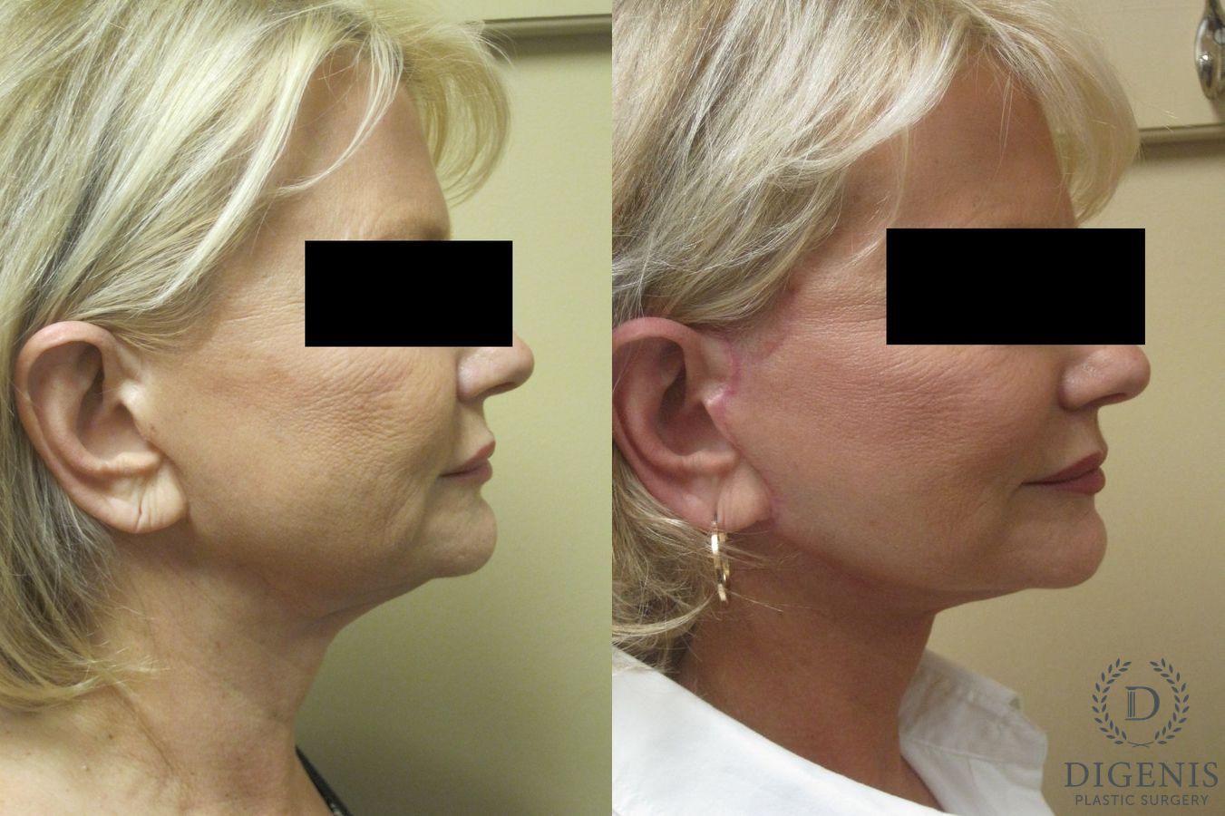 Before and after Face Lift/Neck Lift case 34977 - Angle 3