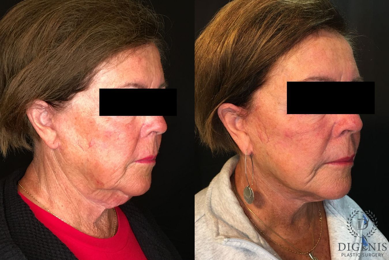 Before and after Face Lift/Neck Lift case 34991 - Angle 2