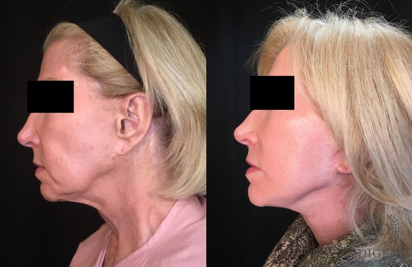 Before and after Face Lift/Neck Lift case 34996 - Angle 5