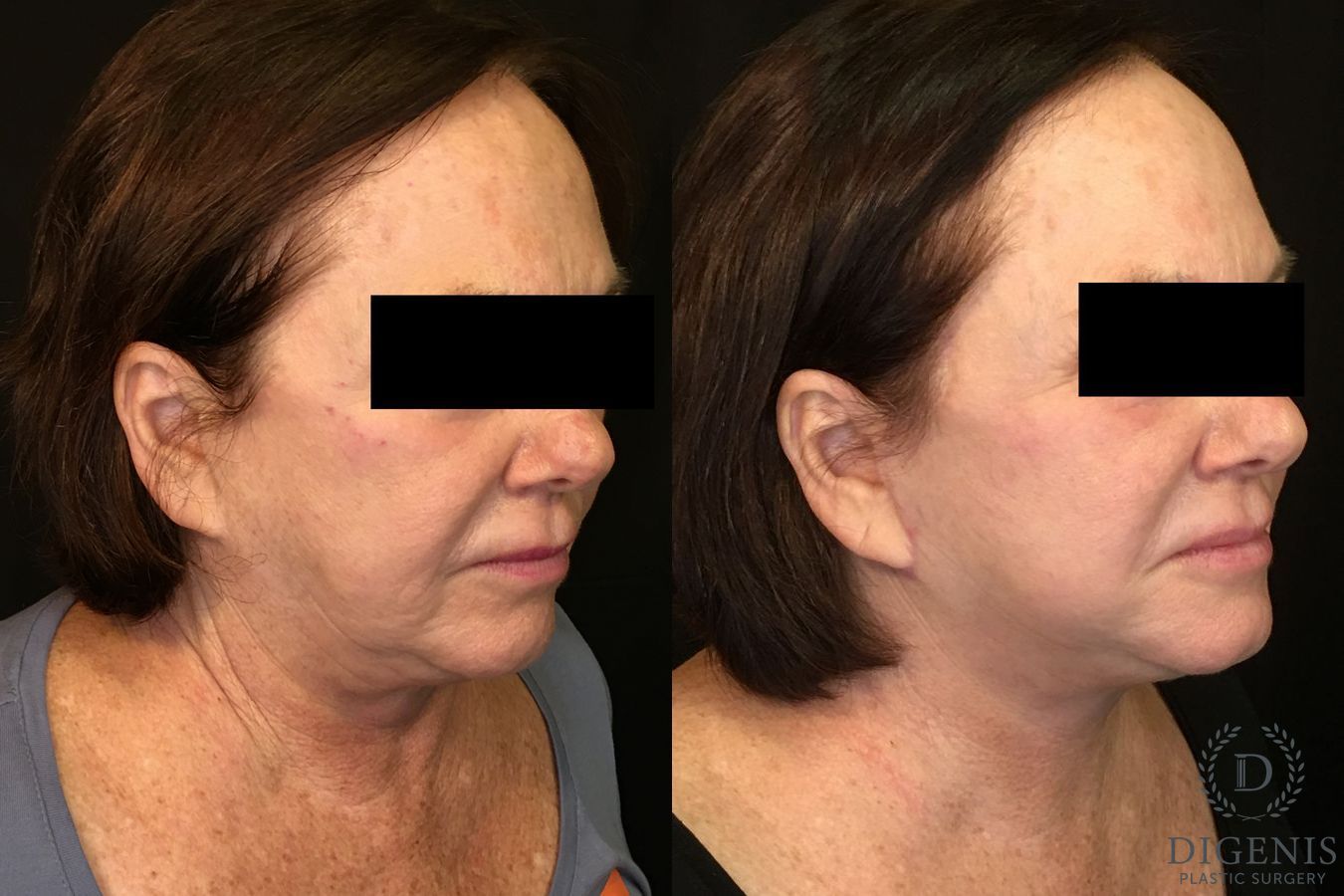 Before and after Face Lift/Neck Lift case 34989 - Angle 2
