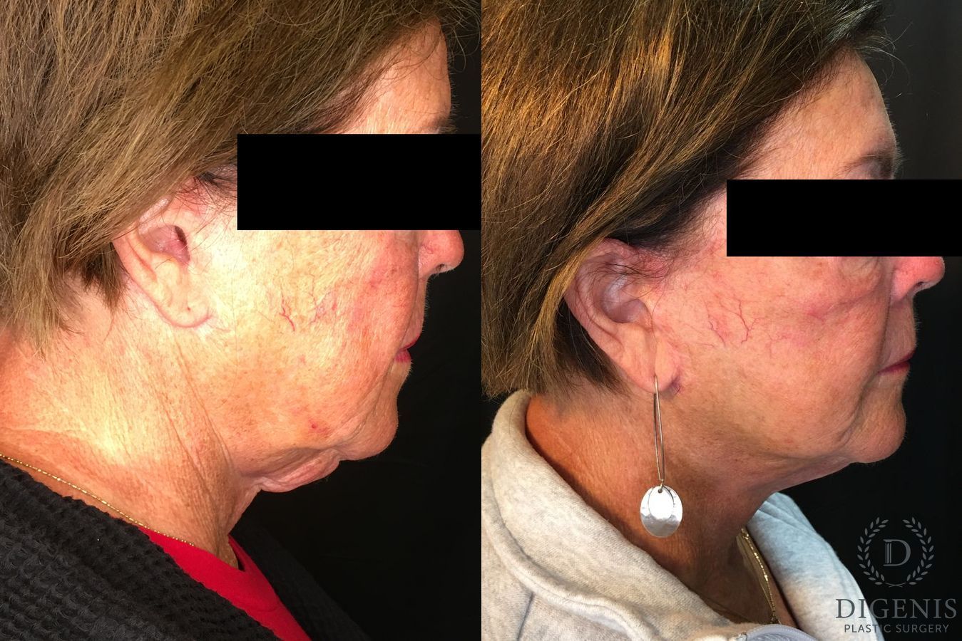 Before and after Face Lift/Neck Lift case 34991 - Angle 3