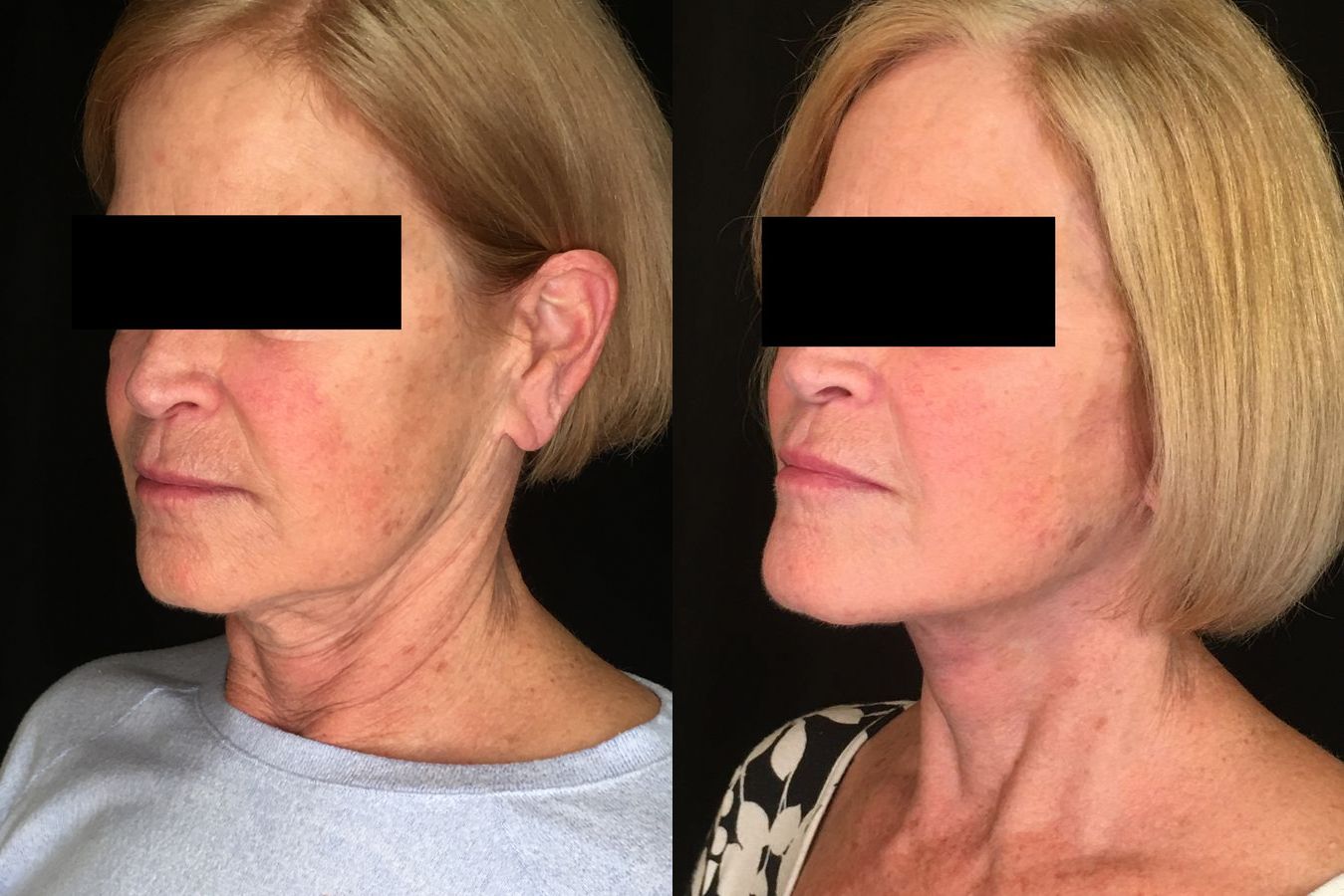 Before and after Face Lift/Neck Lift case 34974 - Angle 4