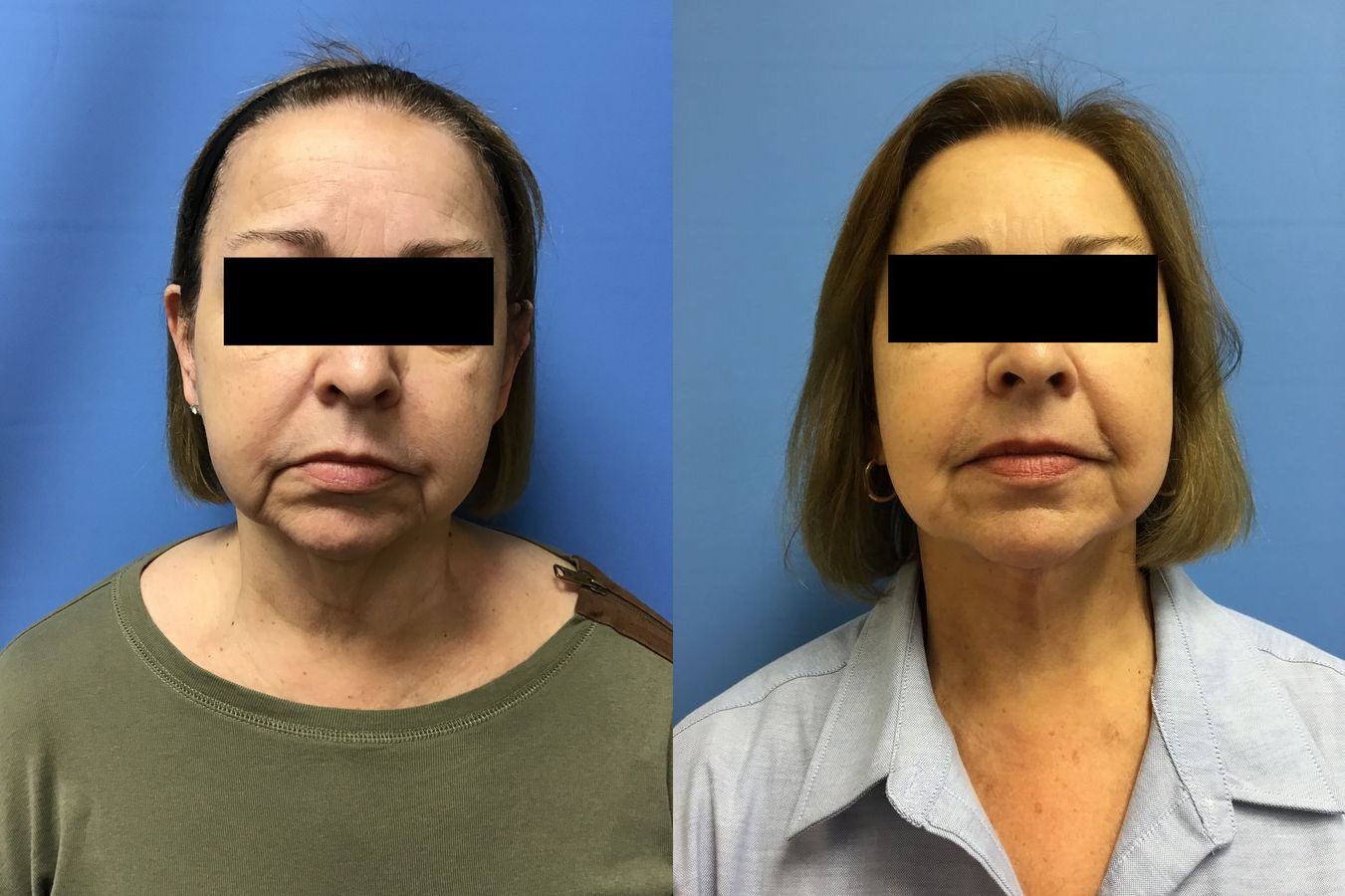 Before and after Facelift case 34970