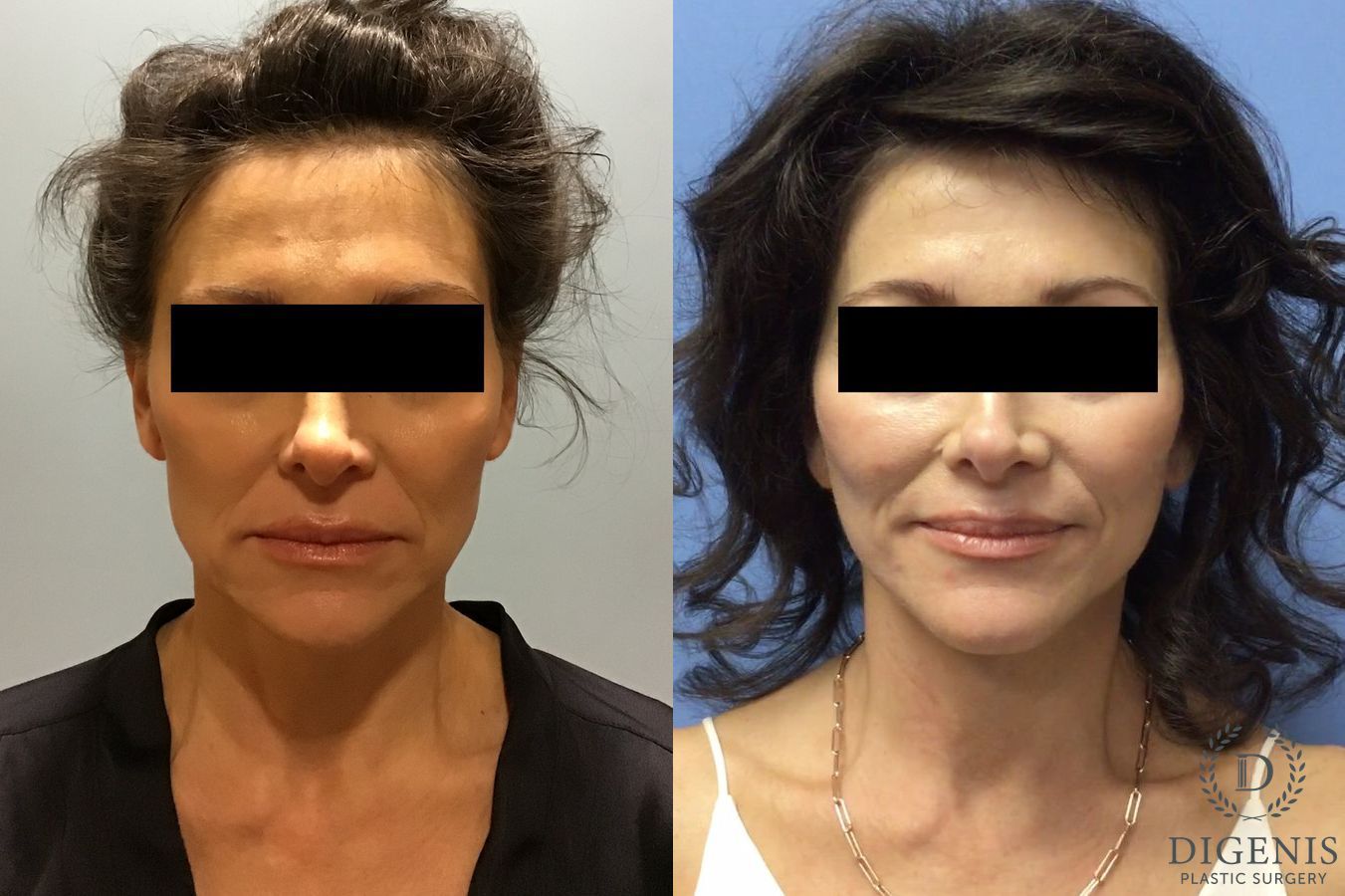 Before and after Facelift case 34982