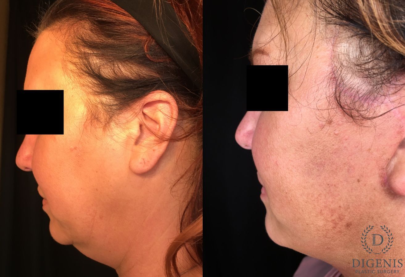 Before and after Face Lift/Neck Lift case 34994 - Angle 5