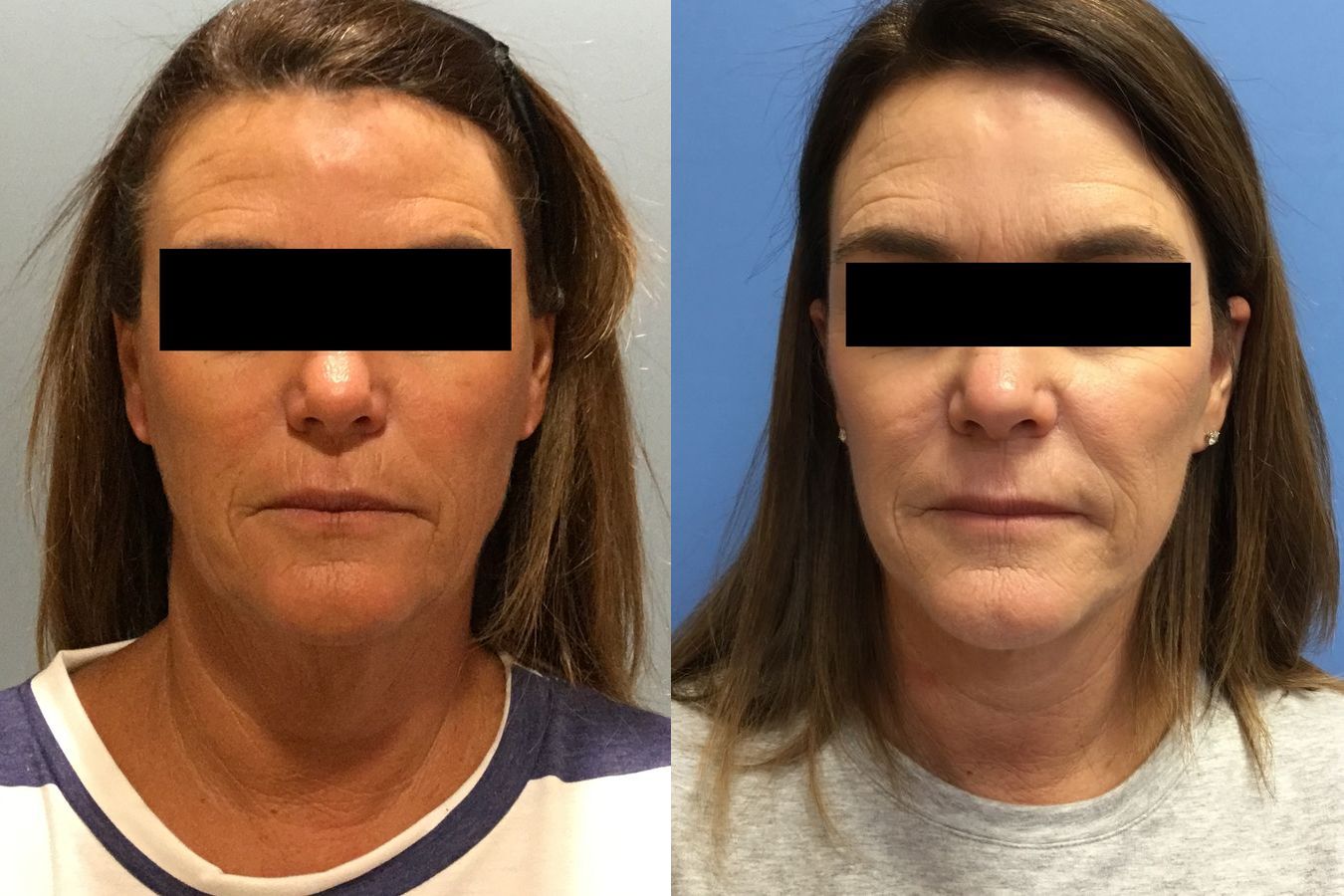 Before and after Facelift case 34966